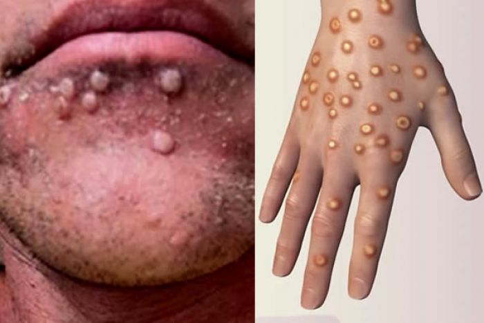 Governo angolano afasta suspeitas de casos de varíola do macaco